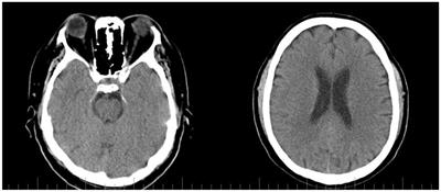 The use of intravenous immunoglobulin in the treatment of Hashimoto’s encephalopathy: case based review